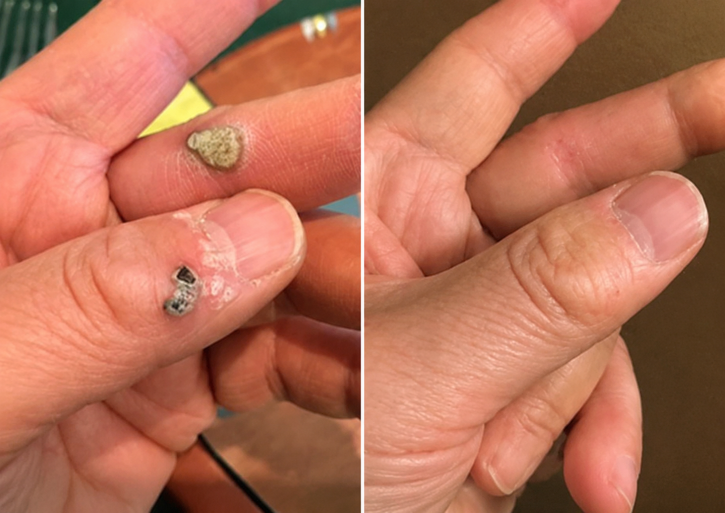 ✨LOVEHERWM®2-in-1 Microneedle & Hydrocolloid Patch🍀| Removes Raised Moles, Acne, Flat Warts & Skin Tags | Helps Improve Wrinkles, Scars & Blemishes | Invisible Patches for Face & Body