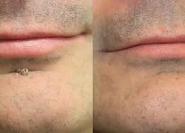 ✨LOVEHERWM®2-in-1 Microneedle & Hydrocolloid Patch🍀| Removes Raised Moles, Acne, Flat Warts & Skin Tags | Helps Improve Wrinkles, Scars & Blemishes | Invisible Patches for Face & Body - Loveherwm