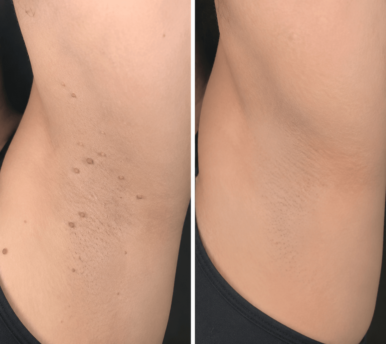 ✨LOVEHERWM®2-in-1 Microneedle & Hydrocolloid Patch🍀| Removes Raised Moles, Acne, Flat Warts & Skin Tags | Helps Improve Wrinkles, Scars & Blemishes | Invisible Patches for Face & Body - Loveherwm