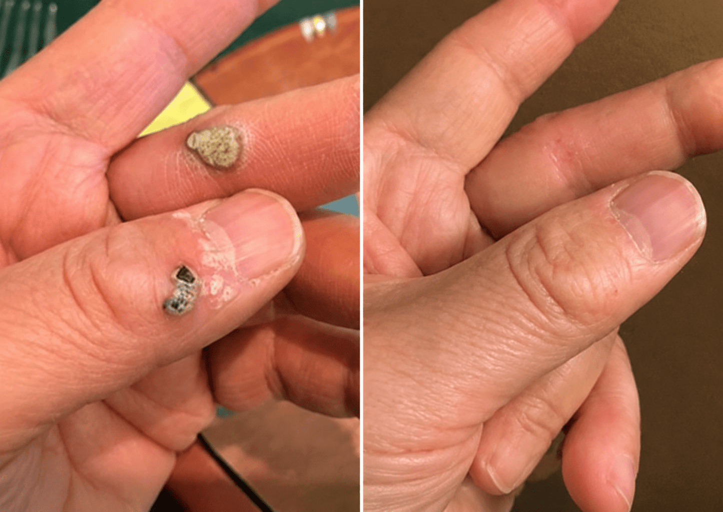 ✨LOVEHERWM®2-in-1 Microneedle & Hydrocolloid Patch🍀| Removes Raised Moles, Acne, Flat Warts & Skin Tags | Helps Improve Wrinkles, Scars & Blemishes | Invisible Patches for Face & Body - Loveherwm